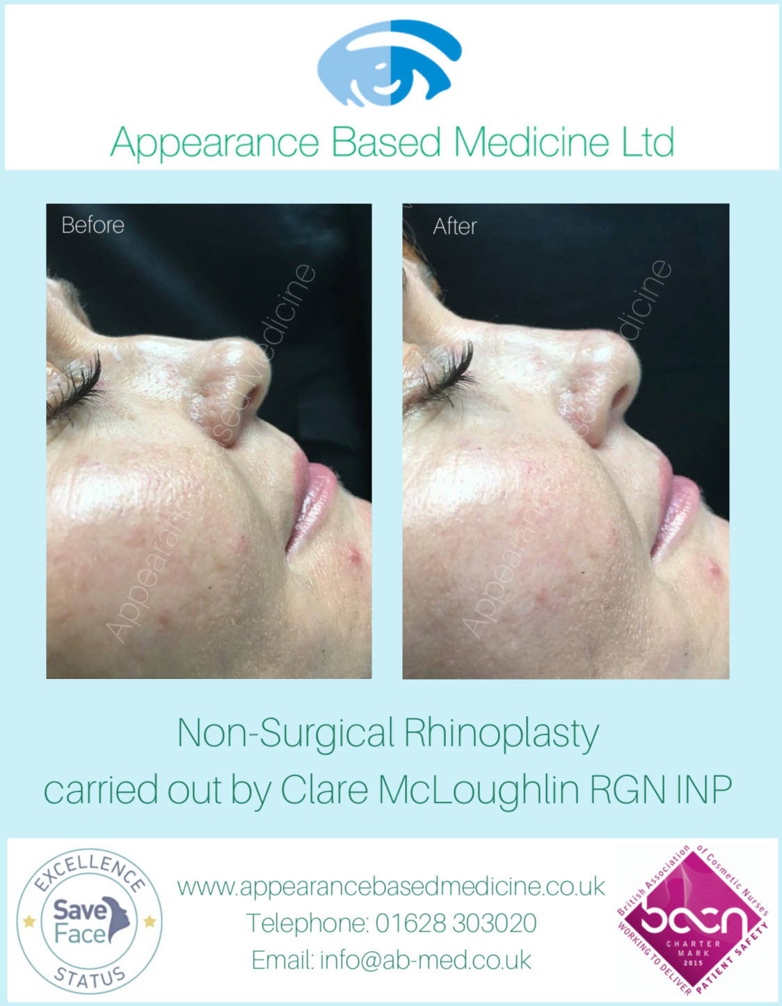 Non surgical rhinoplasty before and after